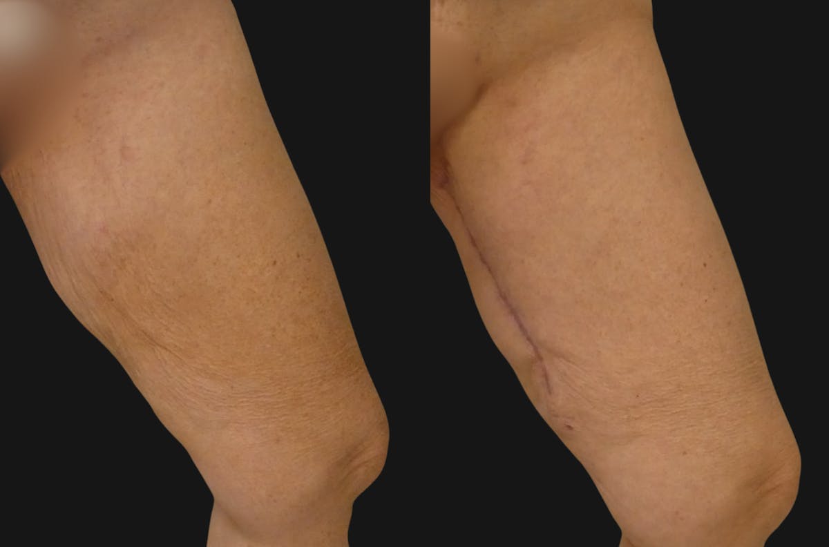 Thigh Lift Before & After Gallery - Patient 366630 - Image 2