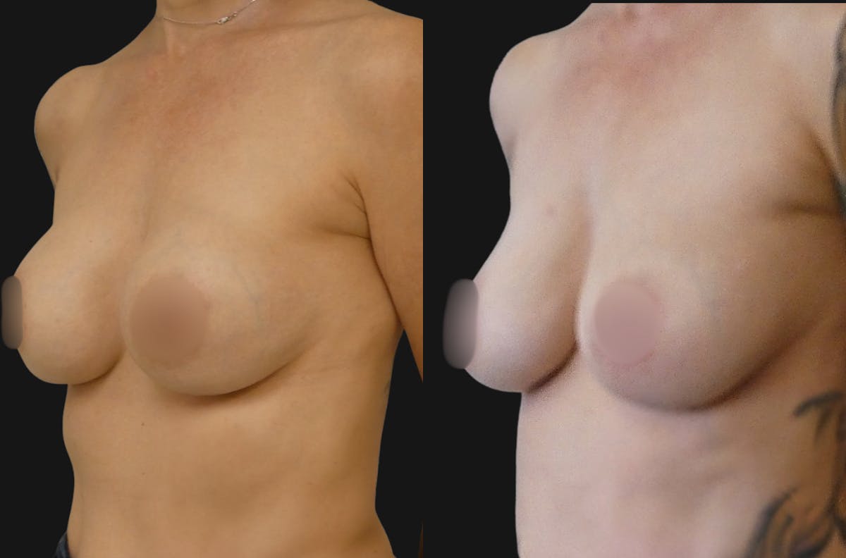 Breast Revision Before & After Gallery - Patient 372396 - Image 4
