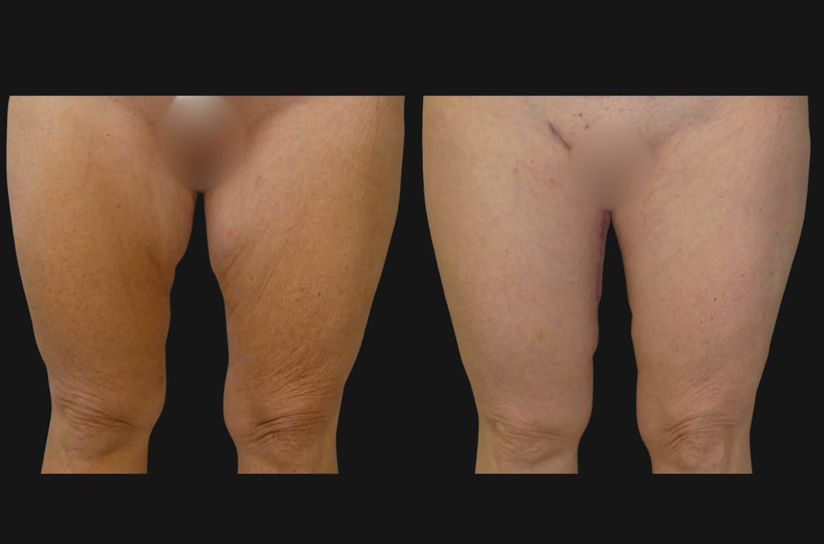 Thigh Lift Before & After Gallery - Patient 366630 - Image 1