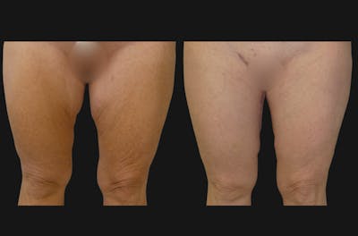 Thigh Lift Before & After Gallery - Patient 366630 - Image 1