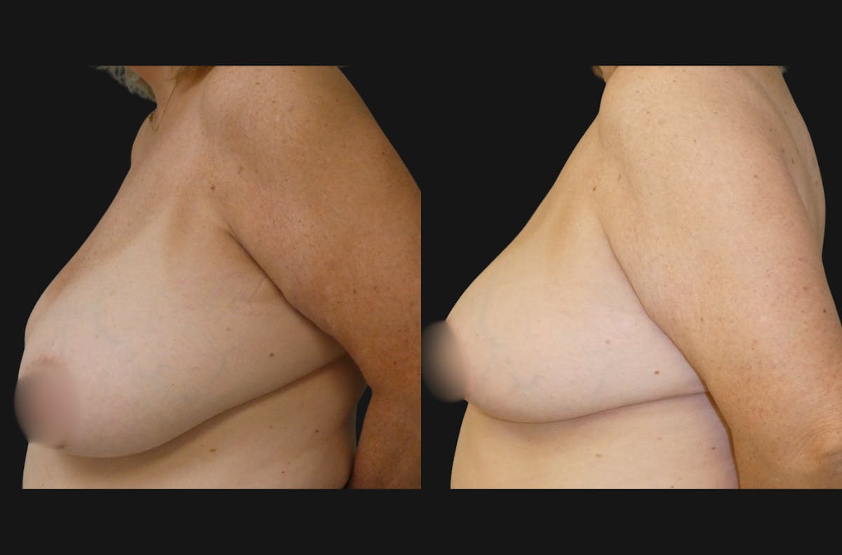 Breast Reduction Before & After Gallery - Patient 116028 - Image 3