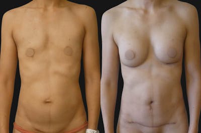 Mommy Makeover Before & After Gallery - Patient 965025 - Image 1