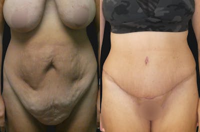 Weight Loss Body Contouring Before & After Gallery - Patient 270288 - Image 1