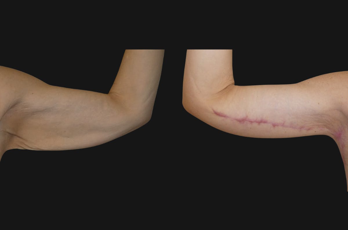 Weight Loss Body Contouring Before & After Gallery - Patient 270288 - Image 4