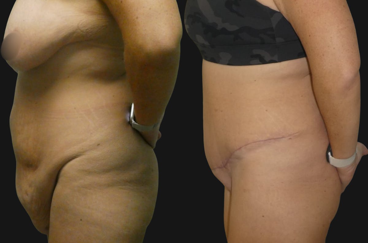 Weight Loss Body Contouring Before & After Gallery - Patient 270288 - Image 2