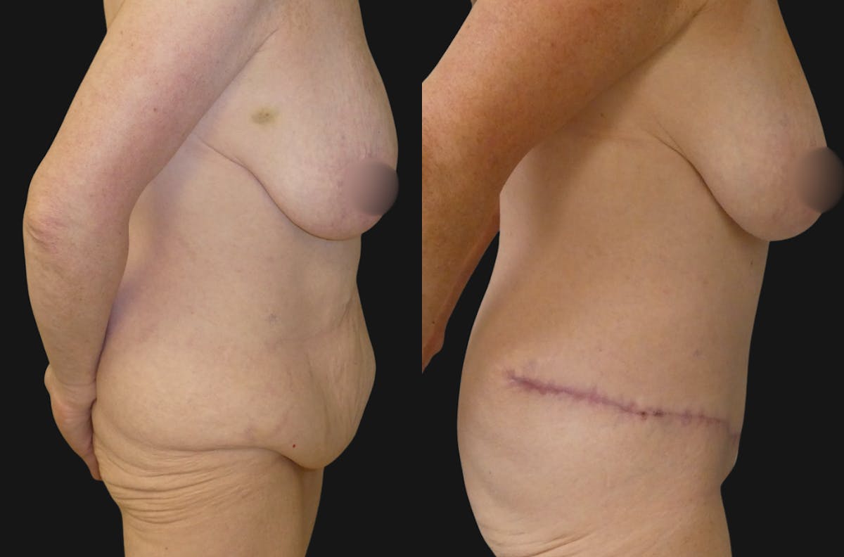 Tummy Tuck / Abdominoplasty Before & After Gallery - Patient 463627 - Image 3