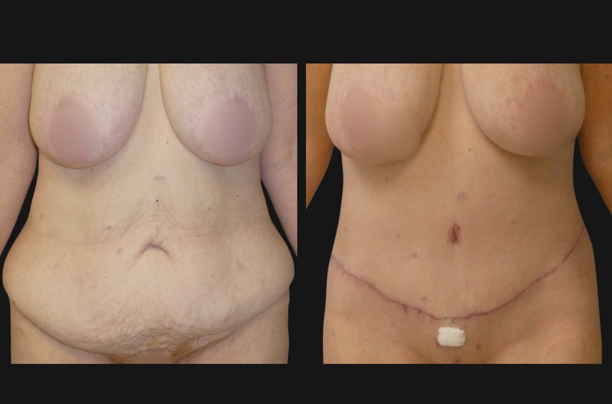 Tummy Tuck / Abdominoplasty Before & After Gallery - Patient 463627 - Image 2