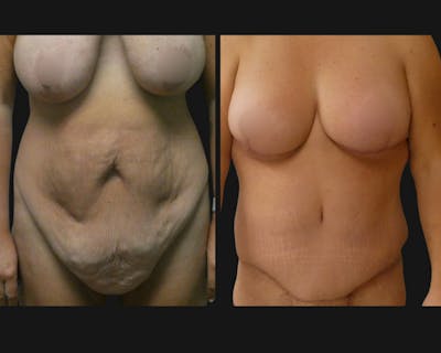 Breast Augmentation Before & After Gallery - Patient 402705 - Image 1