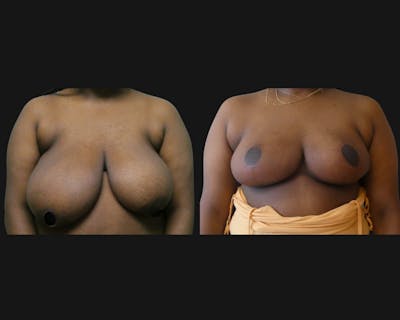 Breast Lift Before & After Gallery - Patient 148619 - Image 1