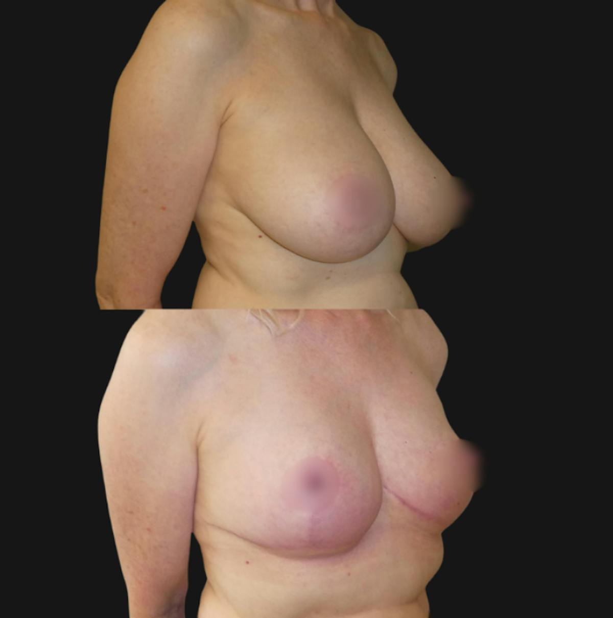 Breast Reduction Before & After Gallery - Patient 391174 - Image 3