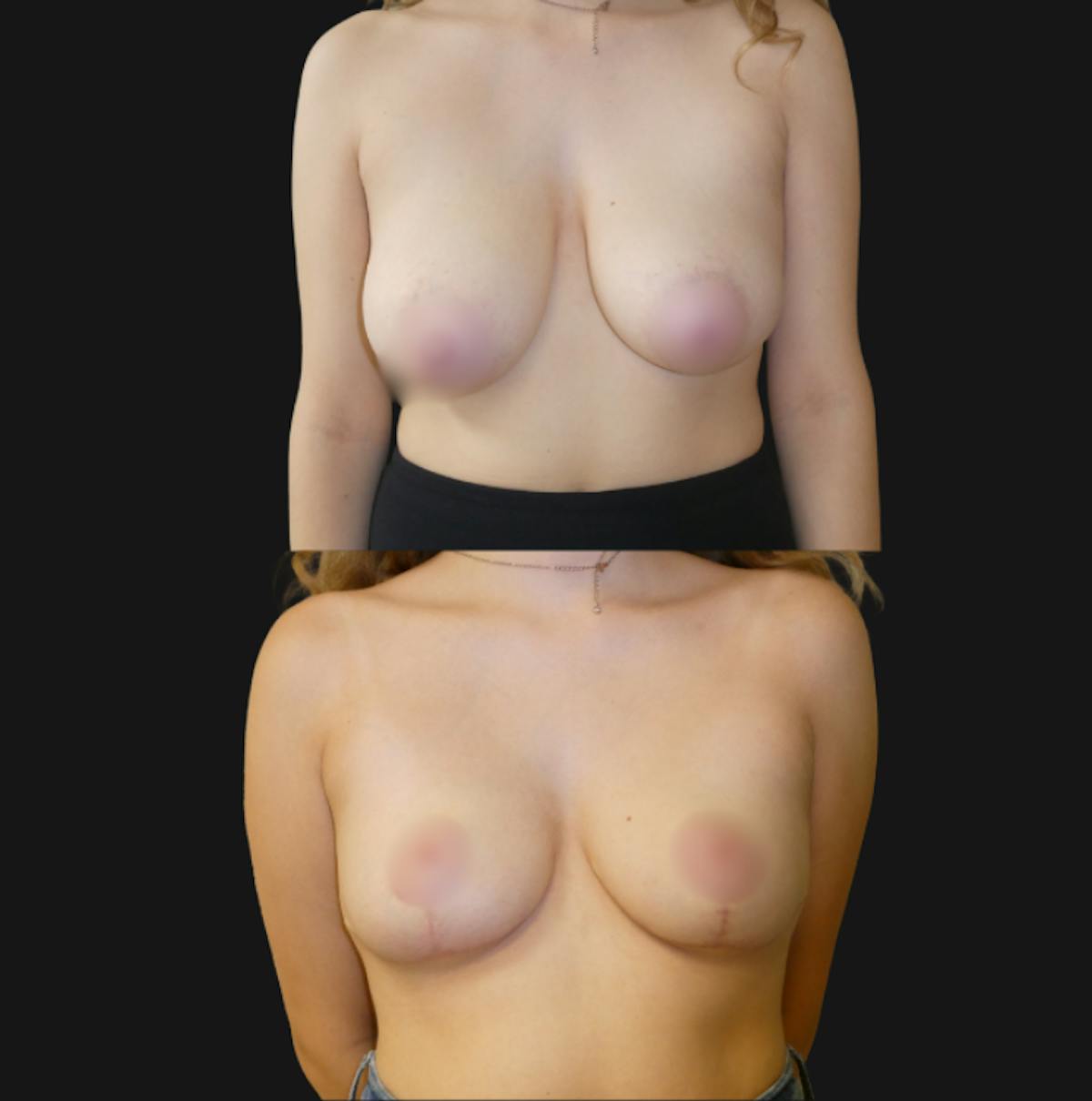 Breast Reduction Before & After Gallery - Patient 179360 - Image 1