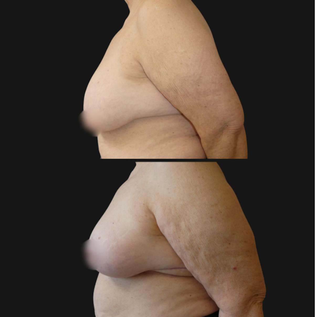 Breast Reduction Before & After Gallery - Patient 557277 - Image 2