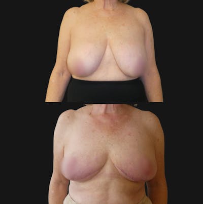 Breast Reduction Before & After Gallery - Patient 362387 - Image 1
