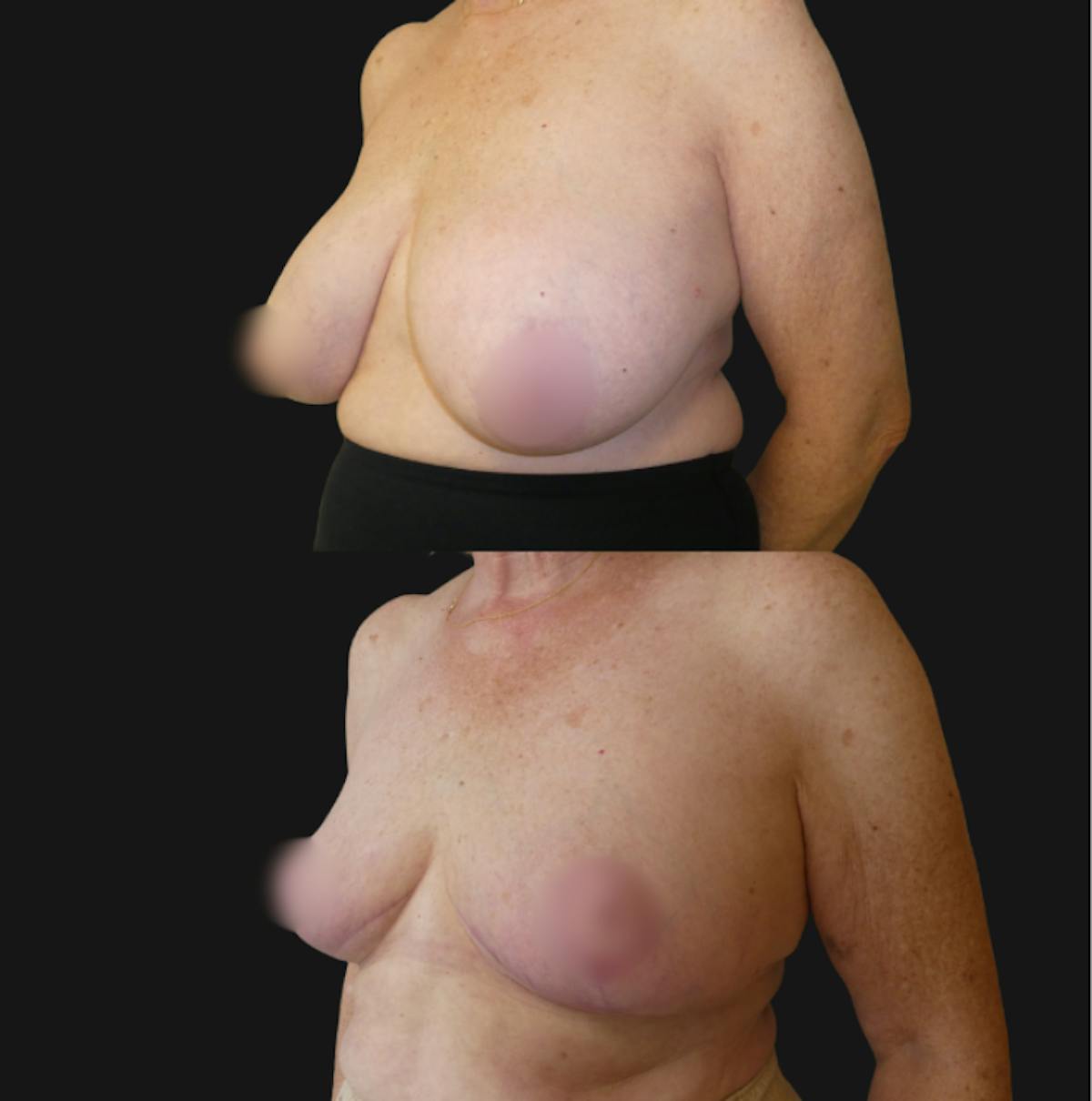 Breast Reduction Before & After Gallery - Patient 362387 - Image 2