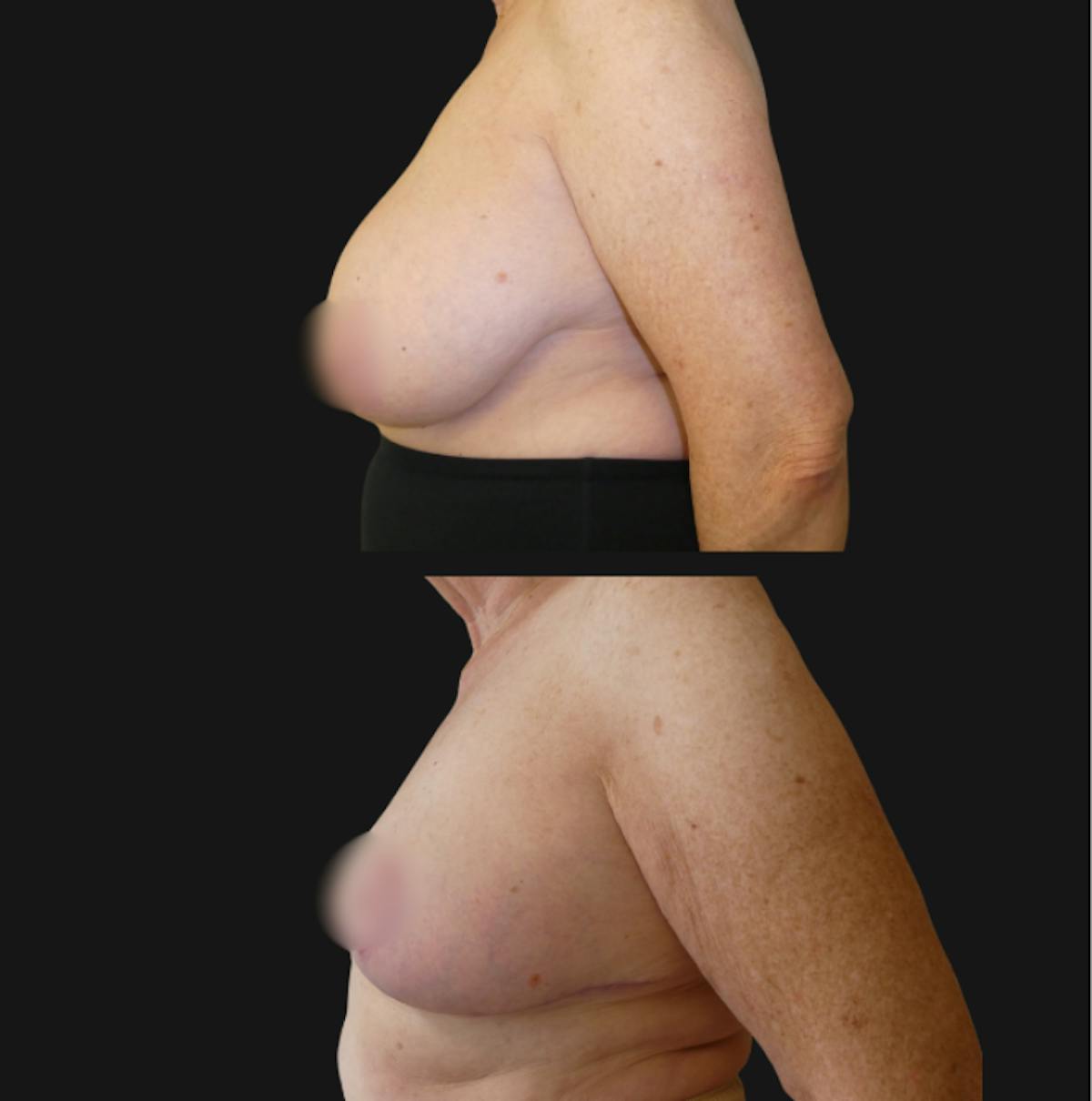 Breast Reduction Before & After Gallery - Patient 362387 - Image 3