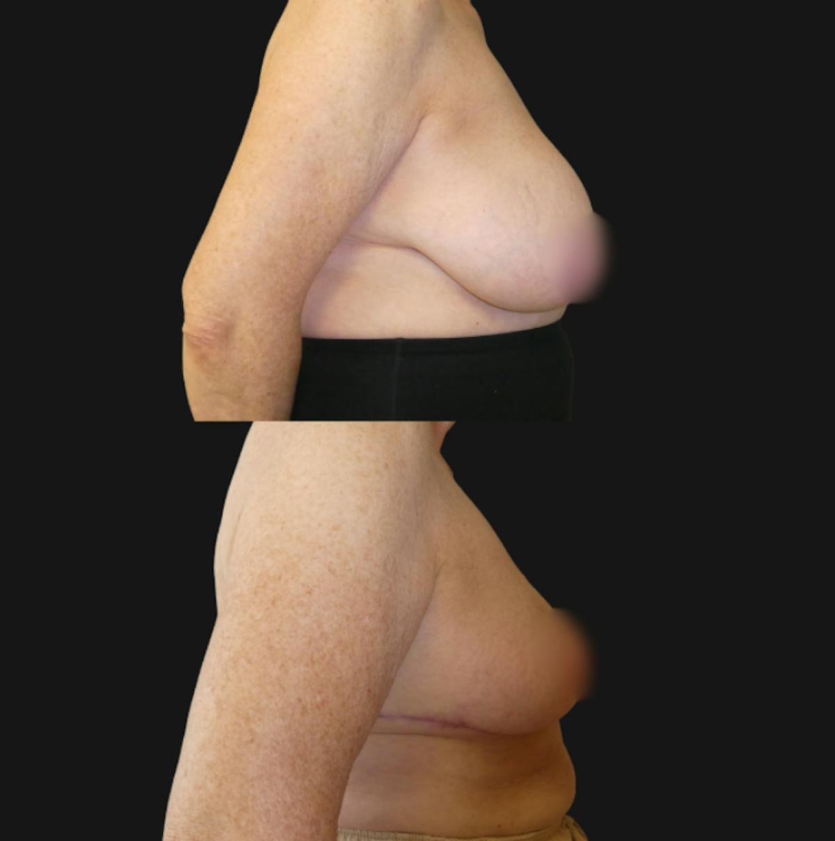 Breast Reduction Before & After Gallery - Patient 362387 - Image 5