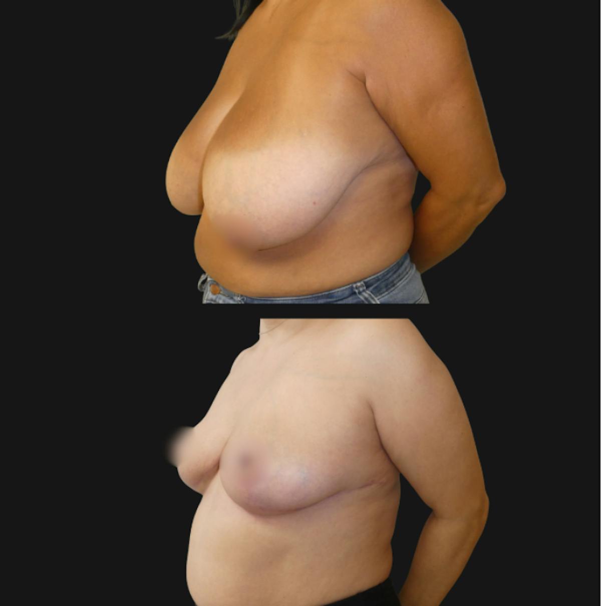Breast Reduction Before & After Gallery - Patient 359490 - Image 4