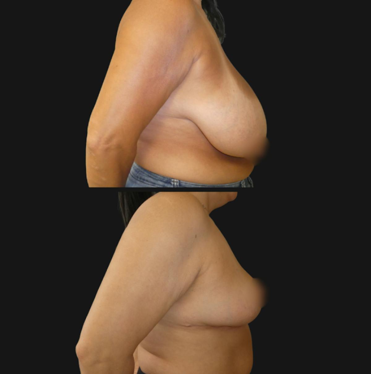 Breast Reduction Before & After Gallery - Patient 359490 - Image 3