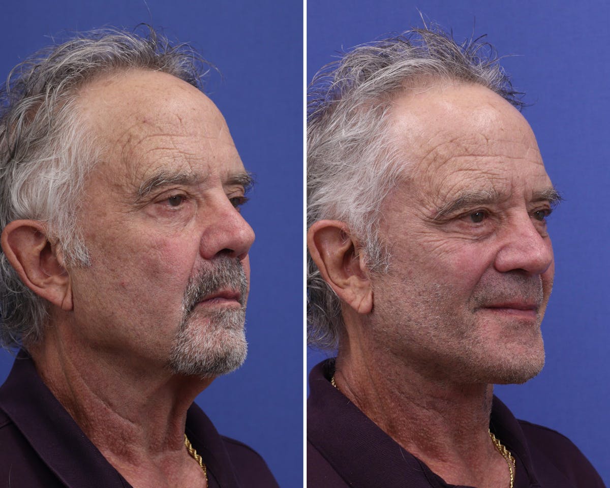 Facelift Before & After Gallery - Patient 163414 - Image 1