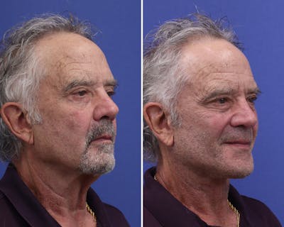 Facelift Before & After Gallery - Patient 163414 - Image 1