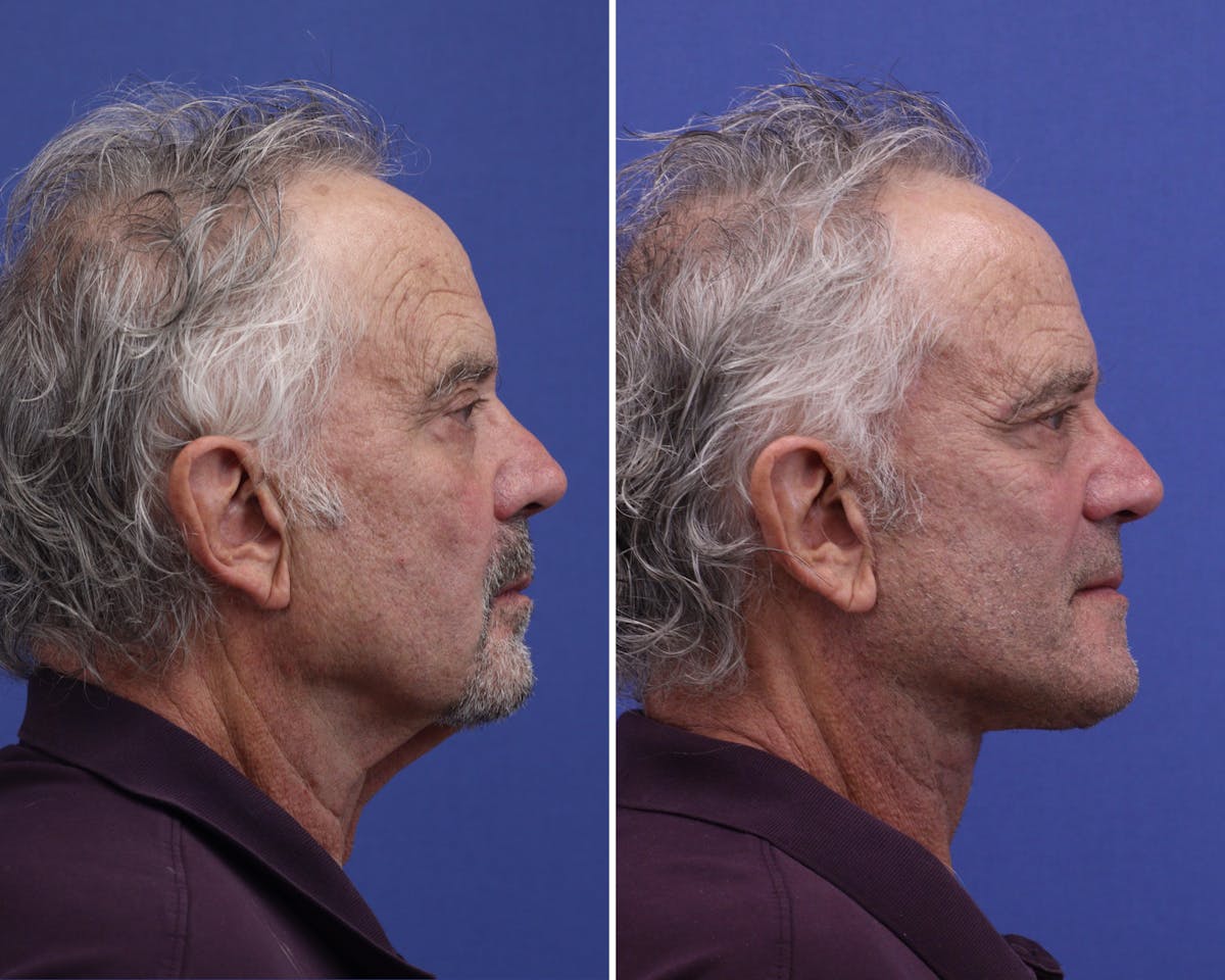 Facelift Before & After Gallery - Patient 163414 - Image 2