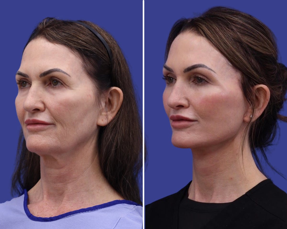 Facelift Before & After Gallery - Patient 403658 - Image 1