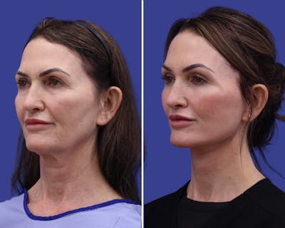 Neck Lift Before & After Gallery - Patient 108006 - Image 1