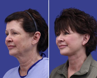 Facelift Before & After Gallery - Patient 421933 - Image 1