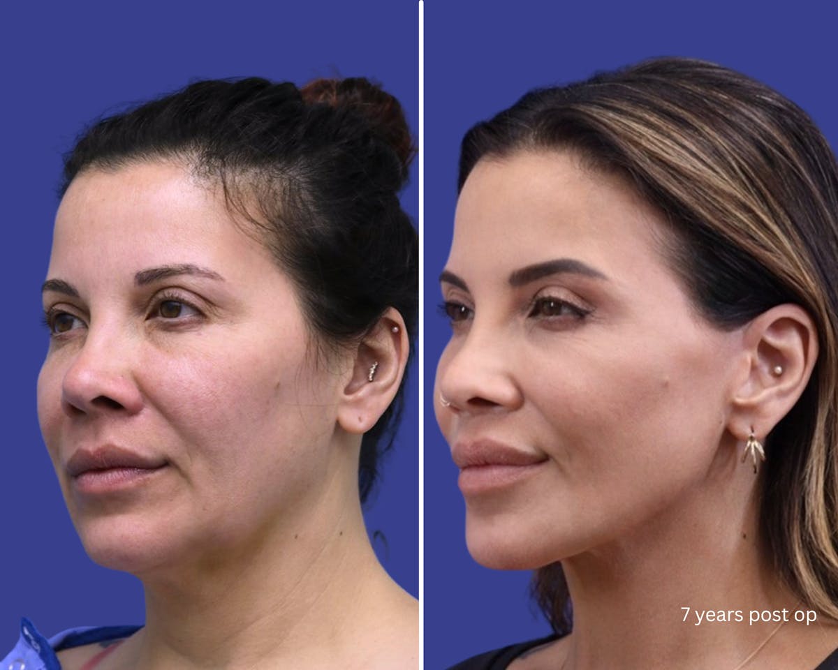 Facelift Before & After Gallery - Patient 376280 - Image 1