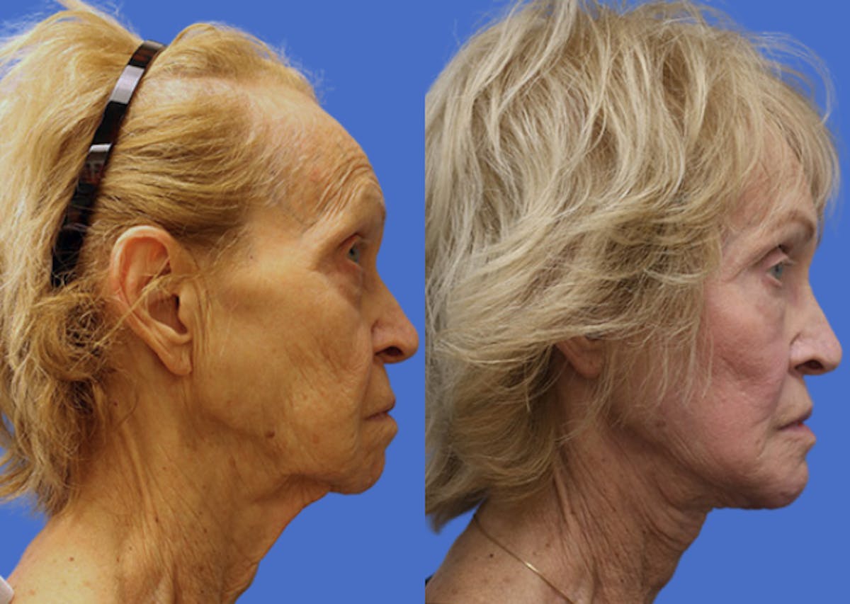 Facelift Before & After Gallery - Patient 211661 - Image 3