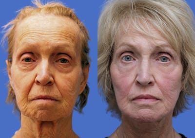 Facelift Before & After Gallery - Patient 211661 - Image 1