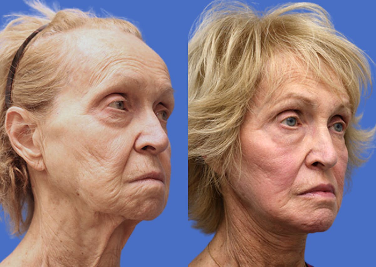 Facelift Before & After Gallery - Patient 211661 - Image 2
