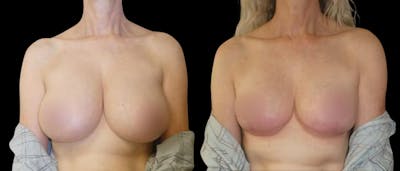Breast Reduction Before & After Gallery - Patient 136497 - Image 1
