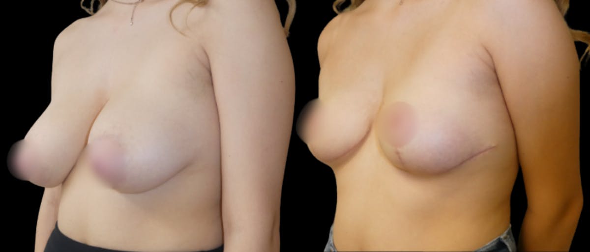 Breast Reduction Before & After Gallery - Patient 179360 - Image 2