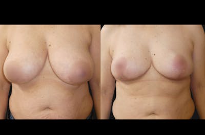 Breast Lift Before & After Gallery - Patient 324986 - Image 1