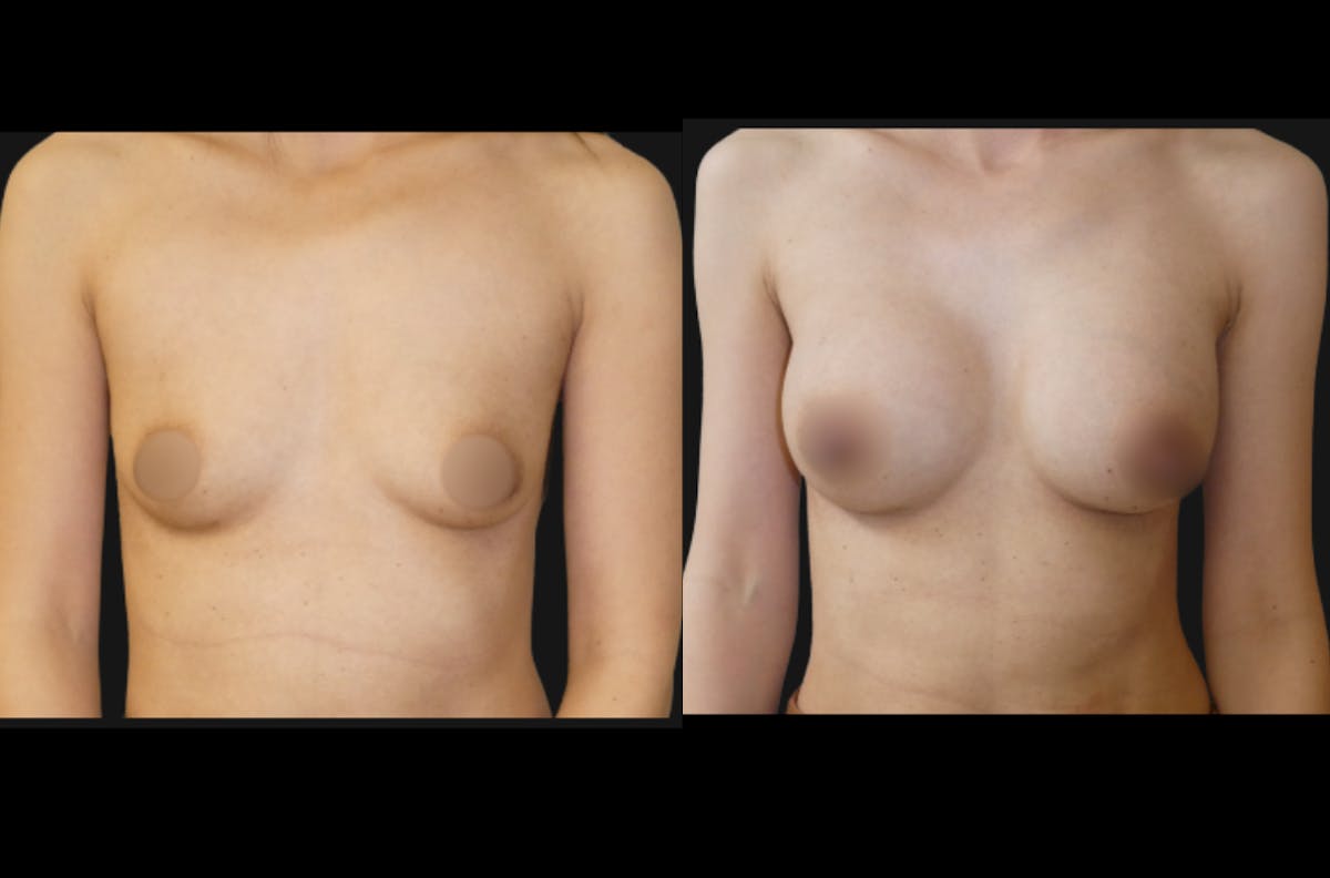 Breast Augmentation Before & After Gallery - Patient 791450 - Image 1