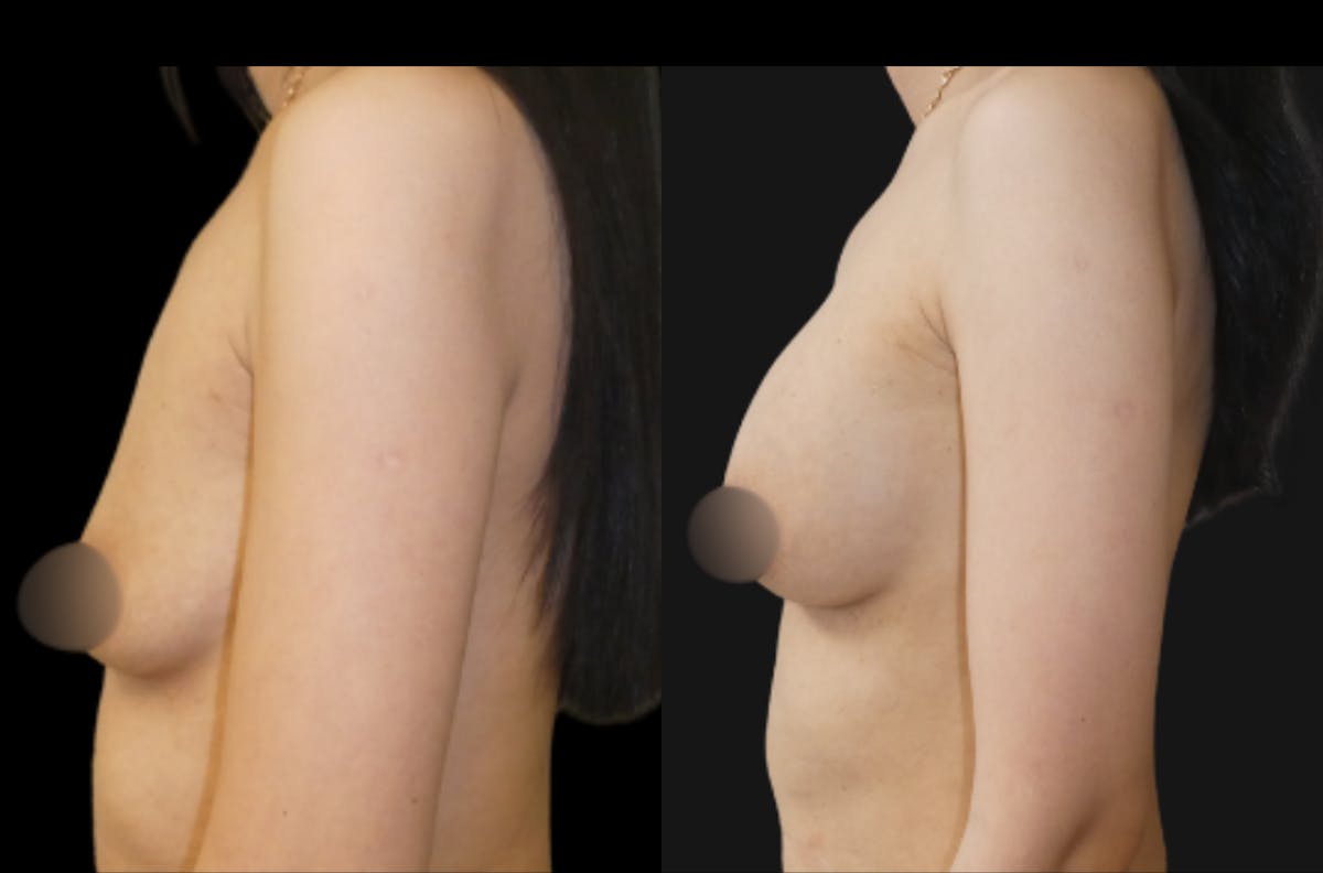 Breast Augmentation Before & After Gallery - Patient 791450 - Image 2