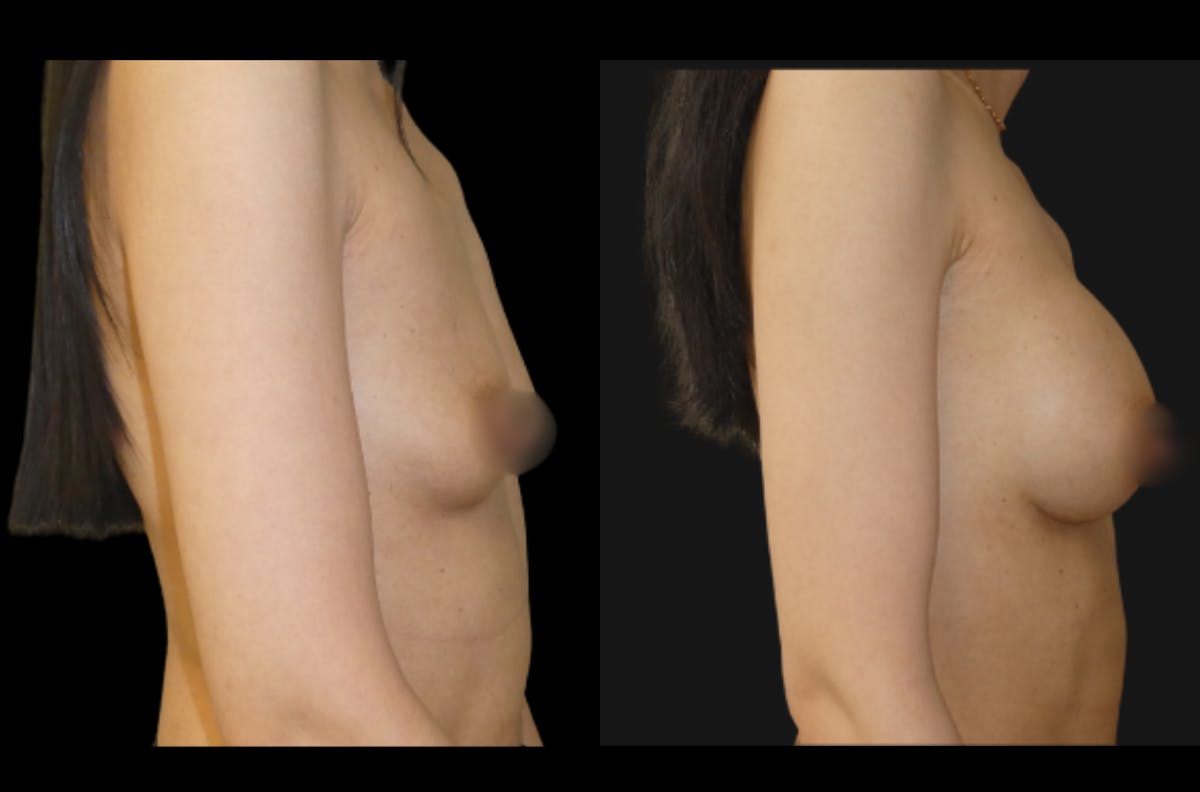 Breast Augmentation Before & After Gallery - Patient 791450 - Image 3