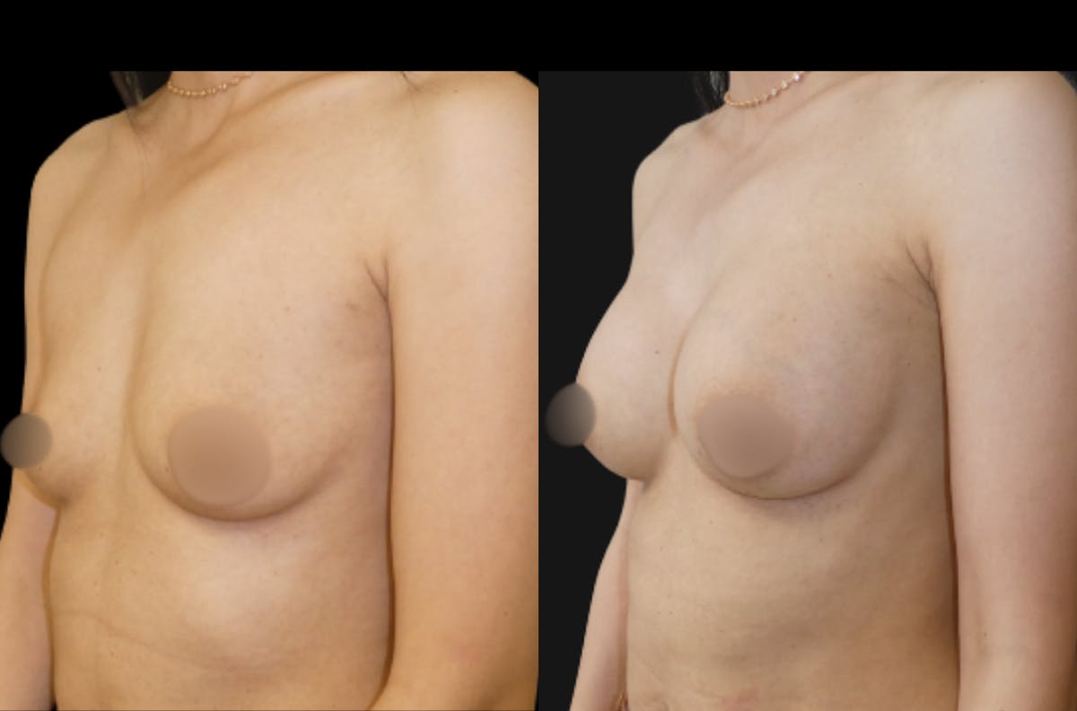 Breast Augmentation Before & After Gallery - Patient 791450 - Image 4