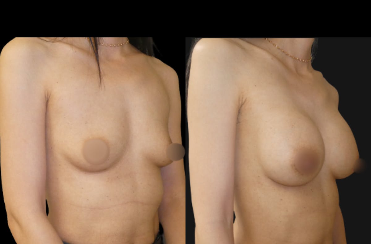 Breast Augmentation Before & After Gallery - Patient 791450 - Image 5