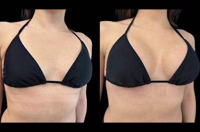 Breast Augmentation Before & After Gallery - Patient 648680 - Image 1
