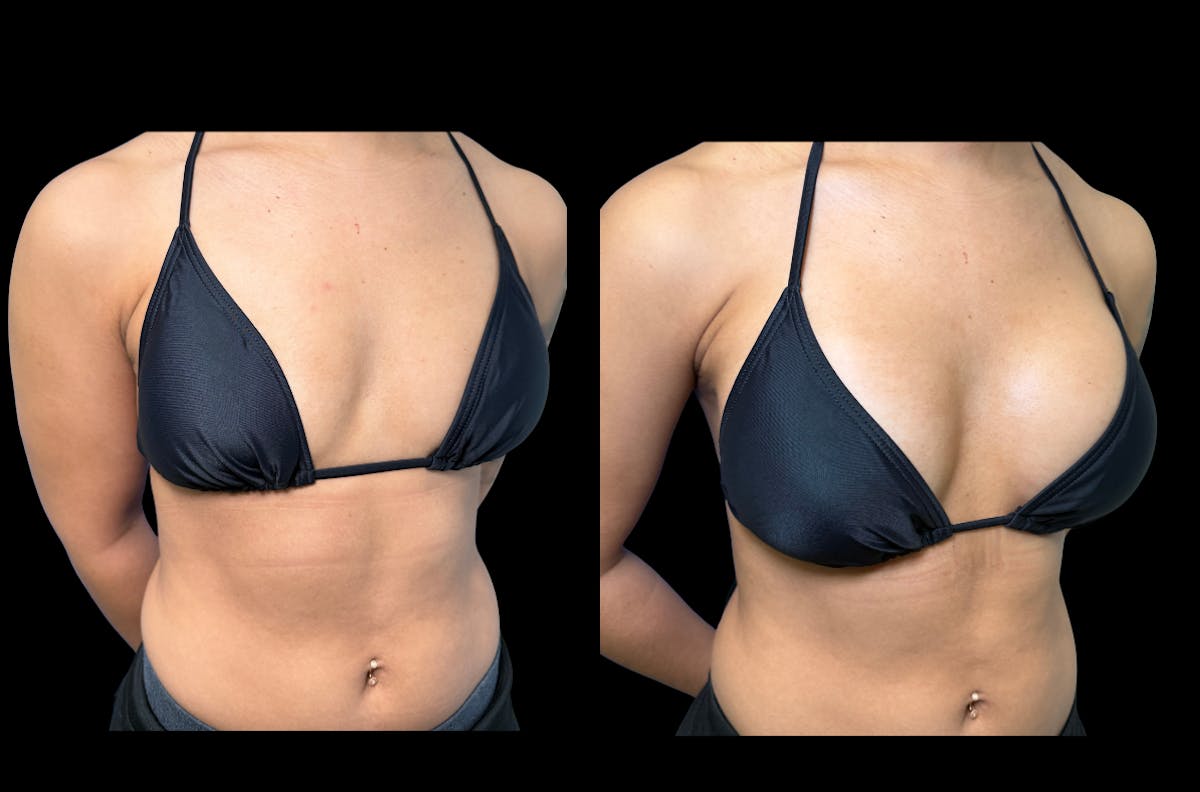 Breast Augmentation Before & After Gallery - Patient 223832 - Image 2
