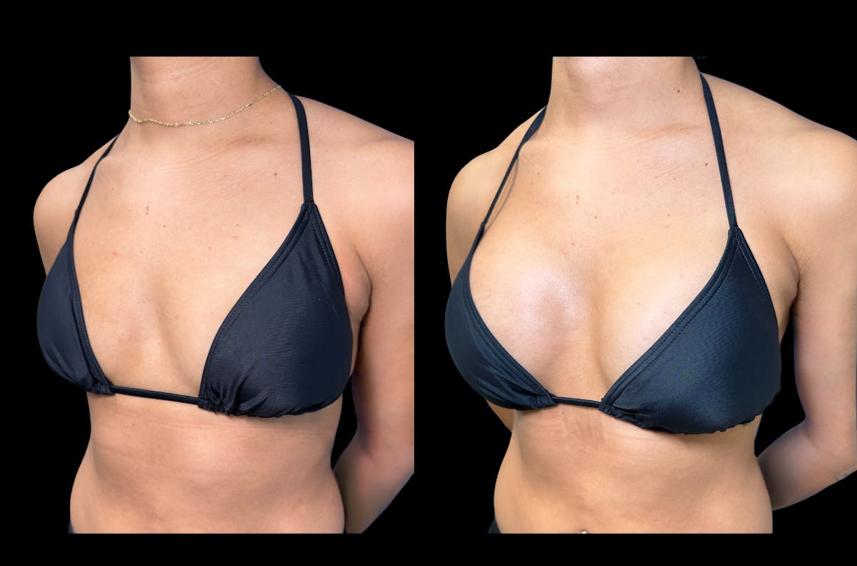 Breast Augmentation Before & After Gallery - Patient 223832 - Image 3
