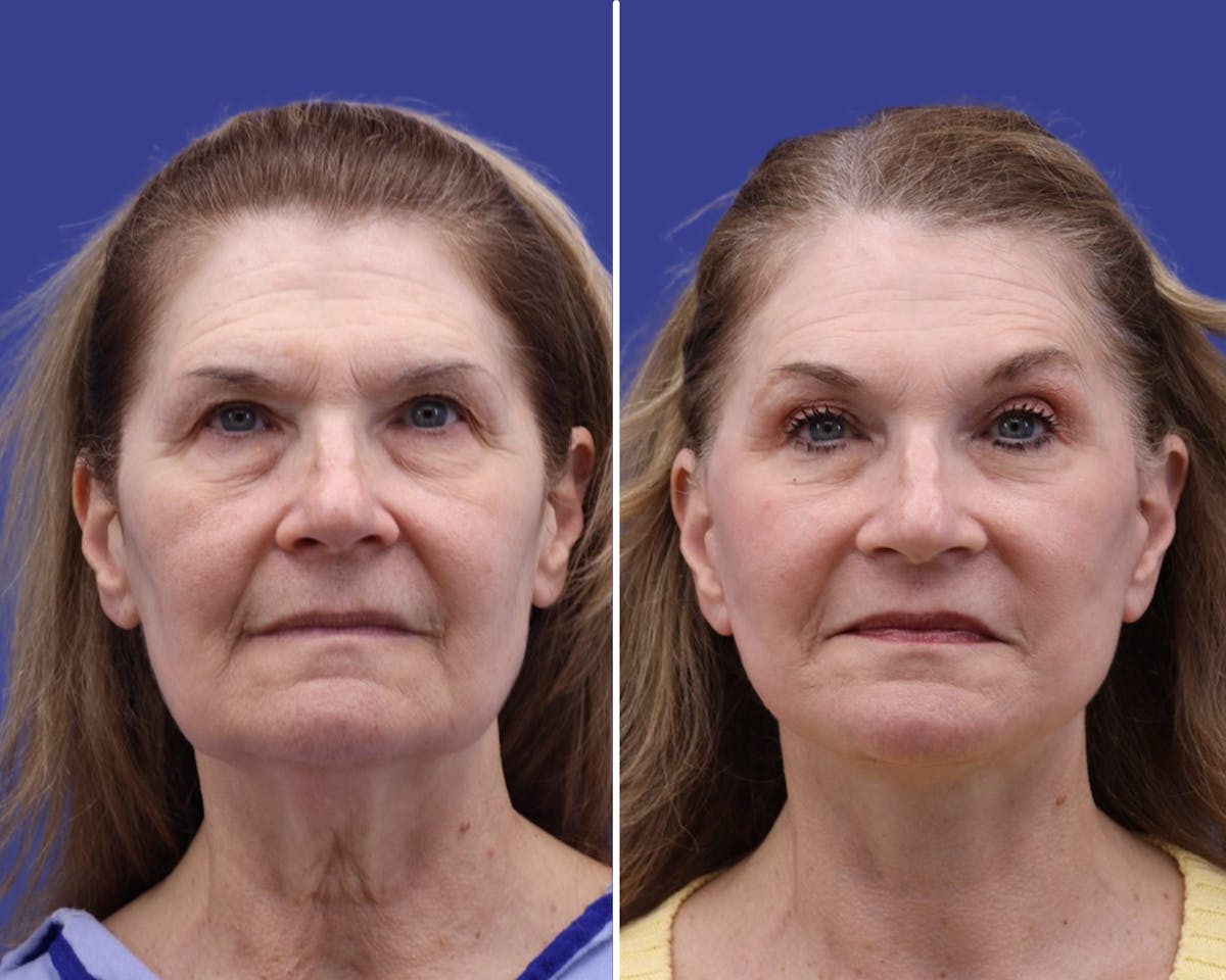 Facelift Before & After Gallery - Patient 165371 - Image 1