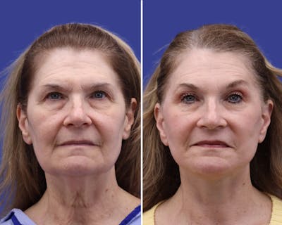 Neck Lift Before & After Gallery - Patient 131418 - Image 1