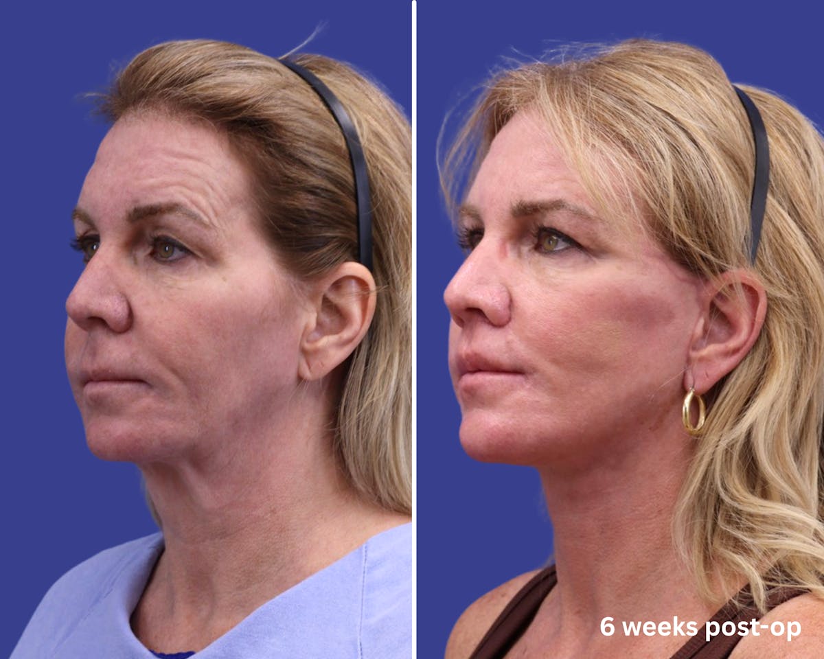 Facelift Before & After Gallery - Patient 377782 - Image 1