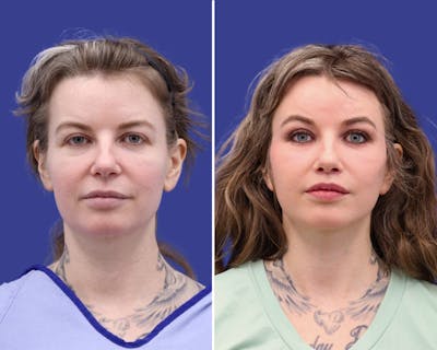Neck Lift Before & After Gallery - Patient 192122 - Image 1