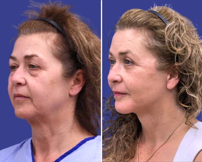 Neck Lift Before & After Gallery - Patient 327681 - Image 1