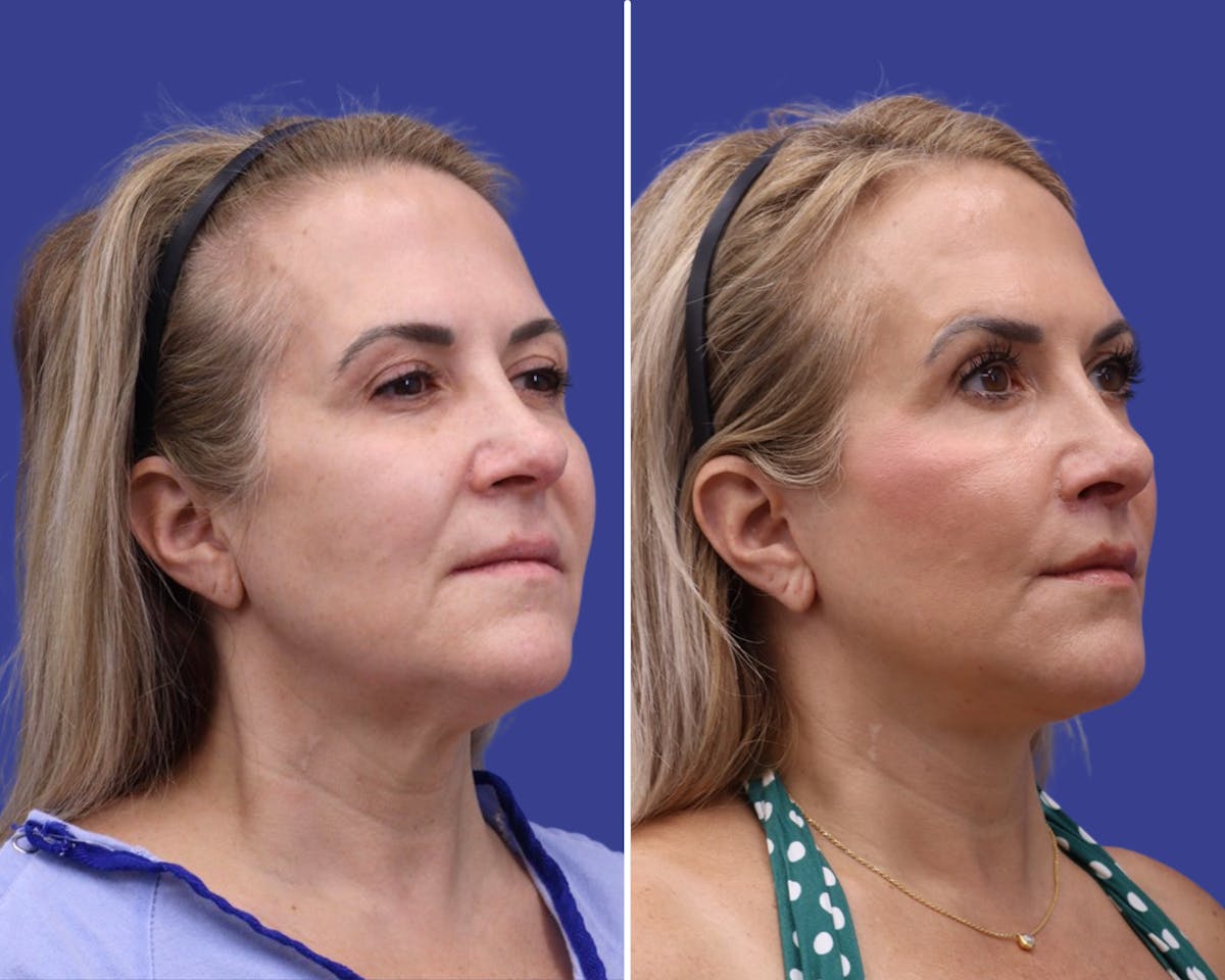 Facelift Before & After Gallery - Patient 226056 - Image 1