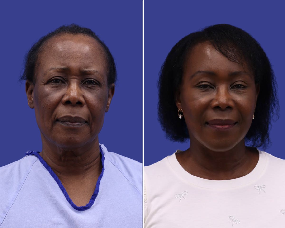 Forehead Reduction Before & After Gallery - Patient 176865 - Image 1